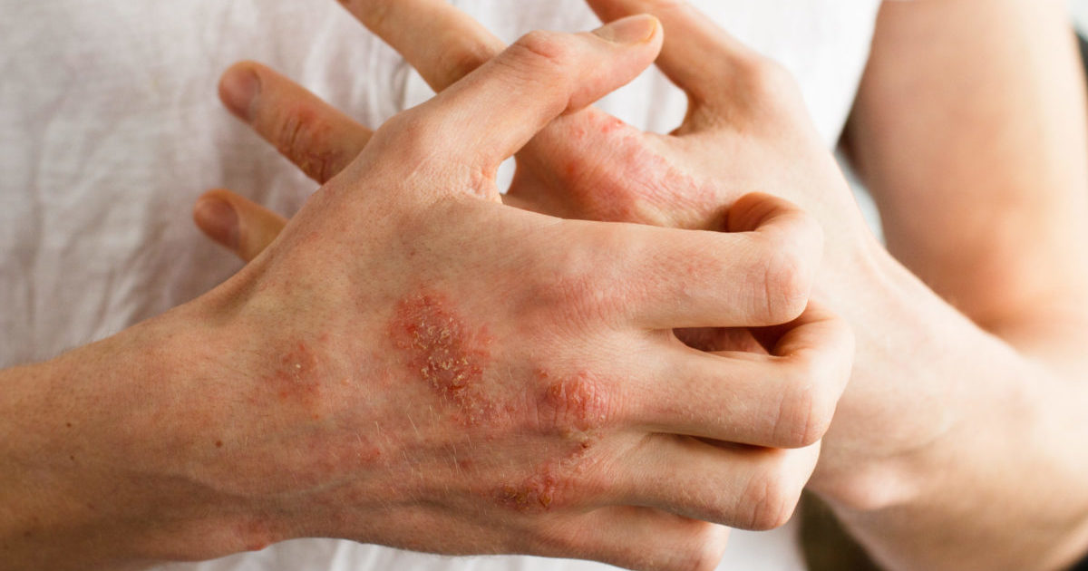Common Skin Problems Caused by Drugs